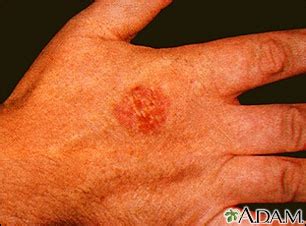 Bowen s disease on the hand: MedlinePlus Medical ...