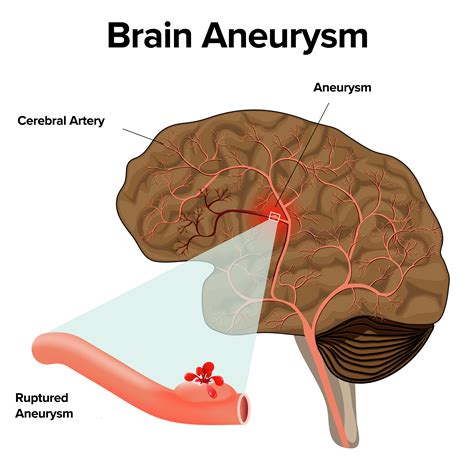 Brain Aneurysm   Symptoms/Treatment | Atlantic Brain & Spine