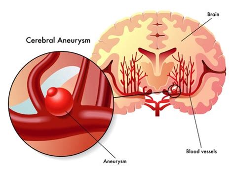 Brain Aneurysm   Treatment in Israel | D.R.A Medical