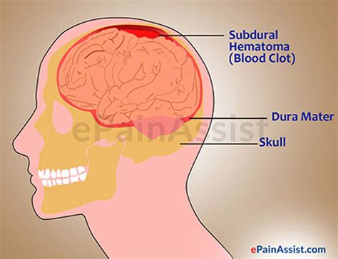 Brain Bleed: After Effects Of Brain Bleed