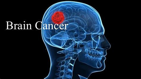 Brain Cancer   Symptoms, Signs, Causes, Stages & Treatment