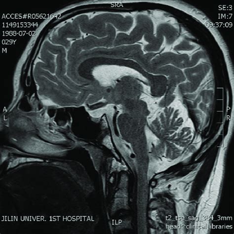 Brain magnetic resonance imaging showed pituitary ...