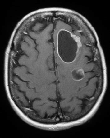 Brain metastases | Radiology Reference Article ...
