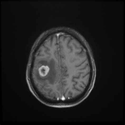Brain metastases  renal cell carcinoma  | Image ...