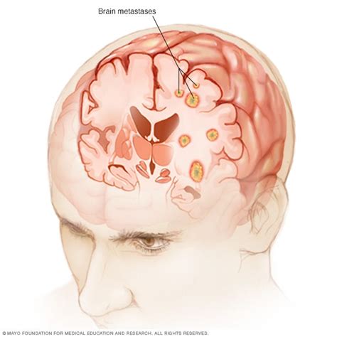 Brain metastases   Symptoms and causes   Mayo Clinic