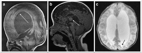 Brain MRI. a T1 weighted sagittal view showing dysplasia ...