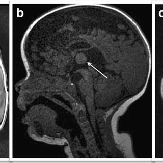 Brain MRI. a T1 weighted sagittal view showing dysplasia ...