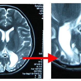 Brain MRI showed the bilateral parietal occipital lobe and ...