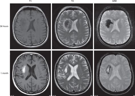 Brain Parenchymal Hematoma Evolution | Radiology Key