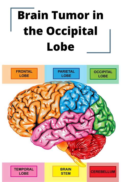 Brain Tumor in the Occipital Lobe in 2020 | Occipital lobe ...