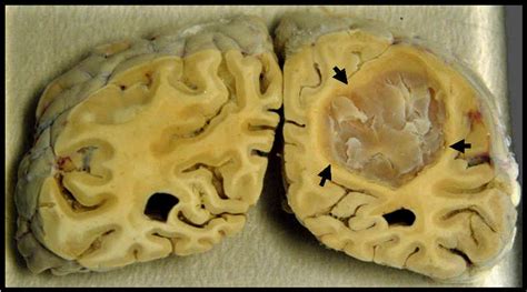 brain tumor picture | Medical Pictures Info   Health ...