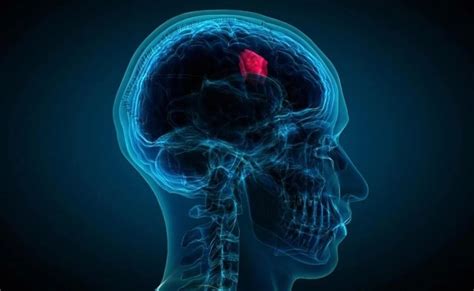 Brain Tumor: Some of the symptoms and signs to look out for