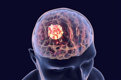Brain Tumor Stages | TNM Stages and Metastasis | Onco.com