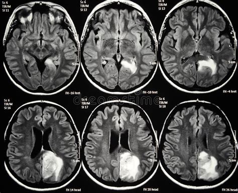 Brain tumor stock image. Image of neurosurgery, therapy ...