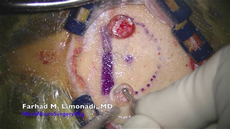 Brain Tumor: Surgical removal of a growing brain tumor ...