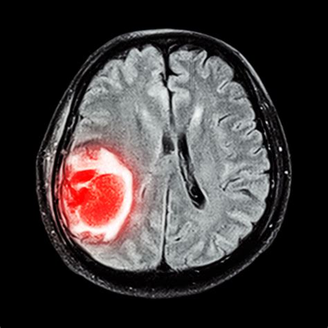 Brain Tumor Symptoms: Not Just in Your Head   University ...