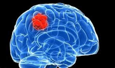 Brain Tumor, Symptoms, Types, Causes and Treatment ...