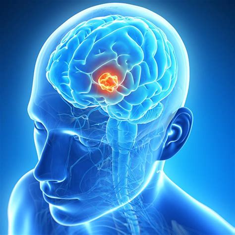 Brain Tumor: Types, Risk Factors, and Symptoms | Dr. Sumit ...
