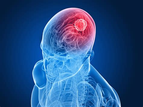 Brain Tumor   Types, Symptoms, Causes and Brain Surgery ...