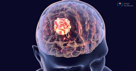 Brain Tumors: Causes, Diagnosis, Symptoms, Types ...