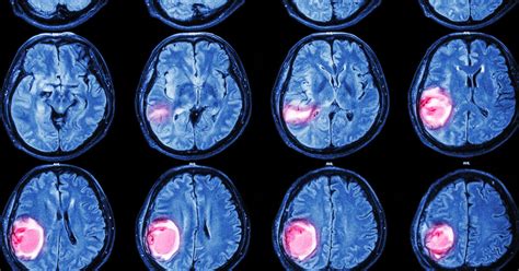 Brain Tumors   Northern VA Brain Surgeon