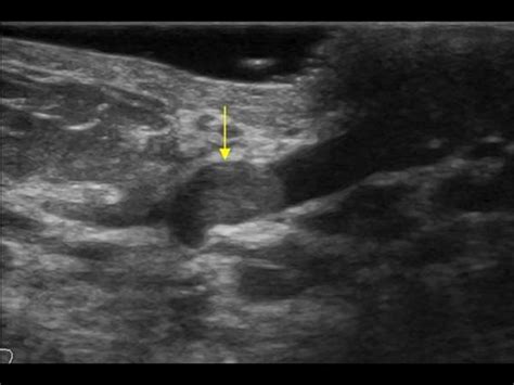 Breast and Axilla | 5.1 Benign lesions : Case 5.1.10 ...