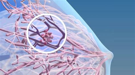 Breast Cancer   3D Medical Animation || ABP    YouTube