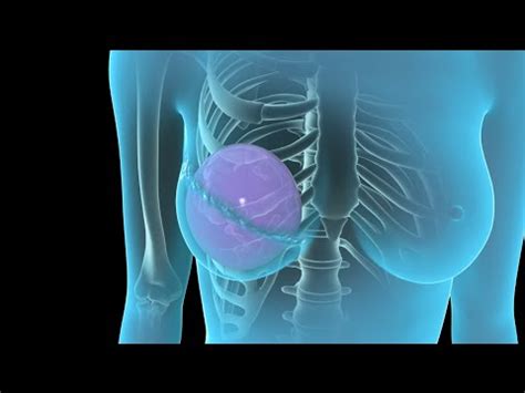 Breast Cancer | Breast Reconstruction | Nucleus Health ...