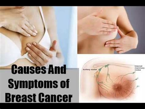 Breast Cancer Causes, Symptoms And Types   YouTube