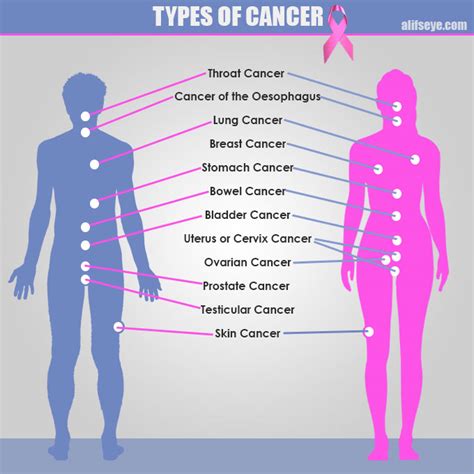 Breast Cancer in Women, Types Breast Cancer   alifseye.com