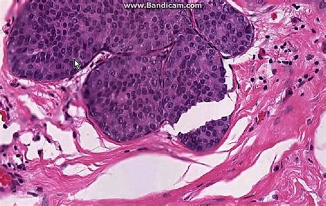 Breast cancer  Lobular carcinoma in situ   YouTube
