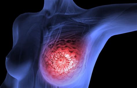 Breast Cancer: Overview and More