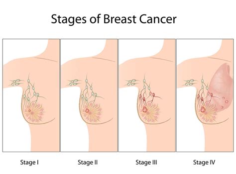 Breast cancer stages   Women Health Info Blog