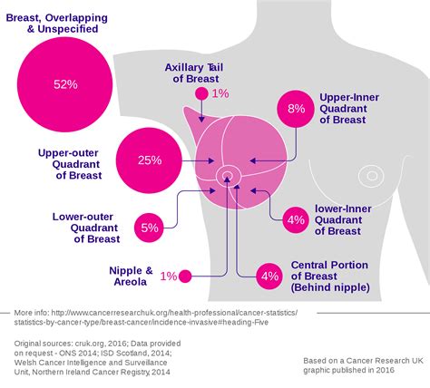 Breast Cancer   Symptoms, Information, Causes, Diagnosis ...