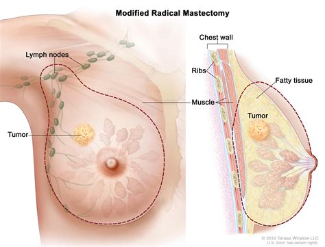 Breast Cancer Treatment  PDQ —Patient Version   National ...