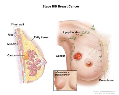 Breast Cancer Treatment  PDQ —Patient Version   National ...