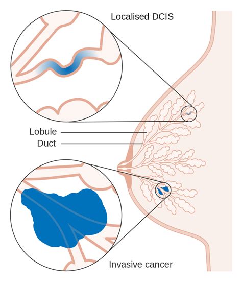 Breast Carcinoma in Situ   Lobular   Ductal   LCIS   DCIS ...
