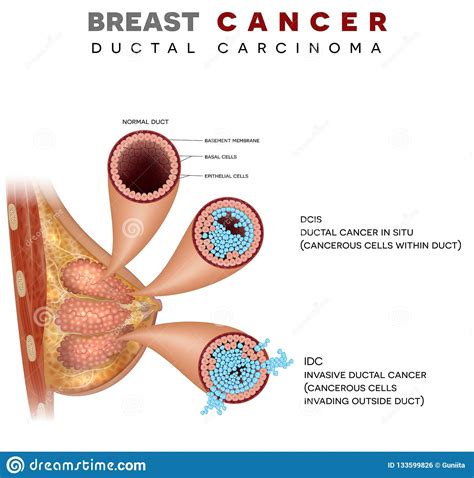 Breast Ductal cancer stock vector. Illustration of diagram ...