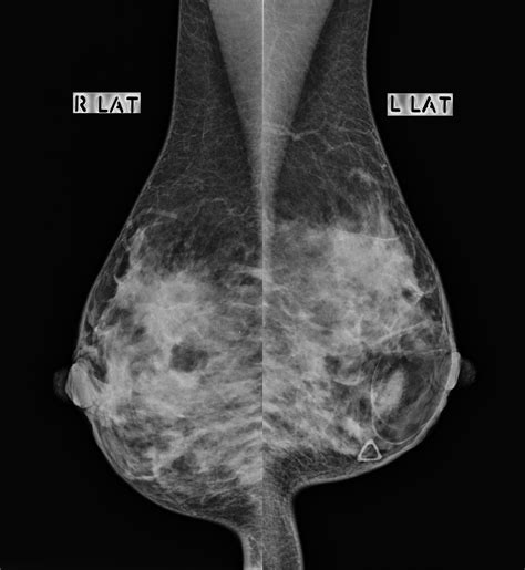 Breast hamartoma | Image | Radiopaedia.org
