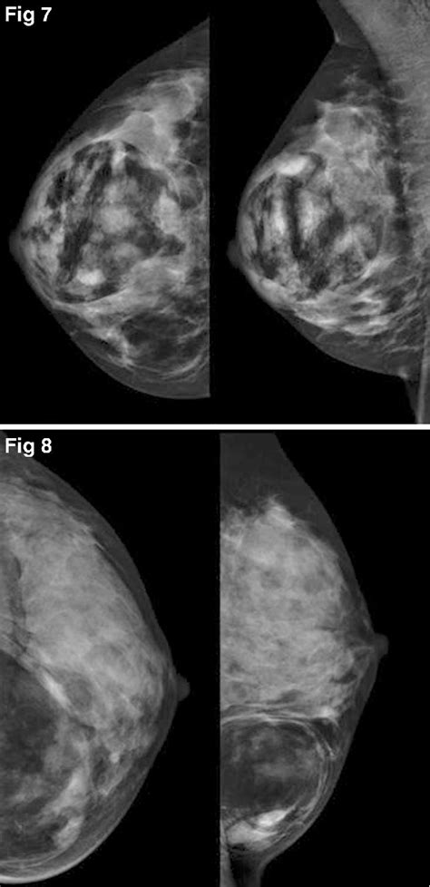 Breast hamartoma: ultrasound, elastosonographic, and mammographic ...