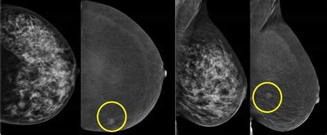 BreastScan define si un cáncer de mama desarrollará o no ...