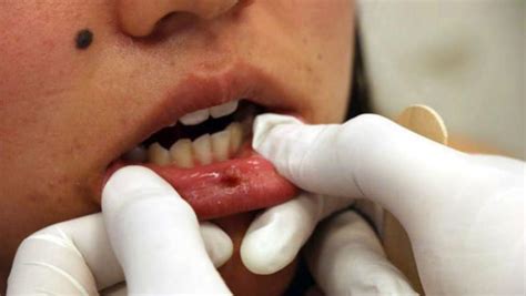 BUAP se suma a prevención de cáncer oral | UN1ÓN | Puebla