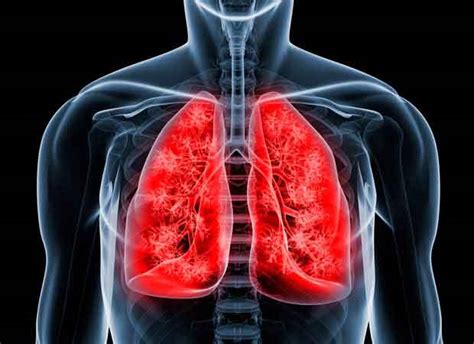 Bulla pulmonar: Qué es, síntomas, tratamiento y más
