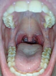 Bultito al lado de la uvula parte izquierda   Dental   CCM Salud