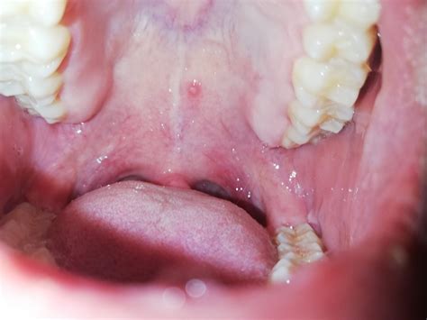 Bultito en paladar   Dental   CCM Salud