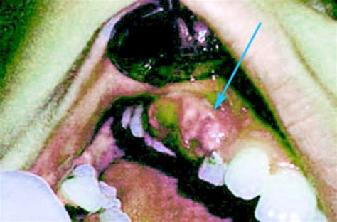 Bultos o tumores benignos orales | Épulis confundibles con cáncer ...