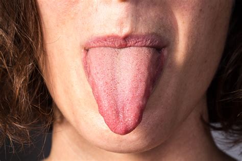 Burning Tongue: 9 Causes, One Life Threatening » Scary ...