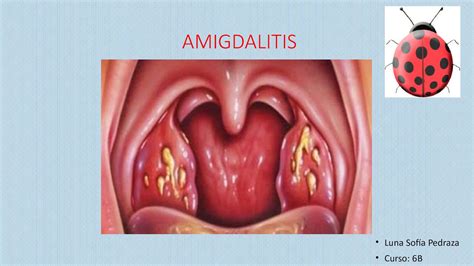 Calaméo   Amigdalitis