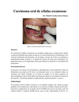 Calaméo   Carcinoma Oral De Celulas Escamosas Docx