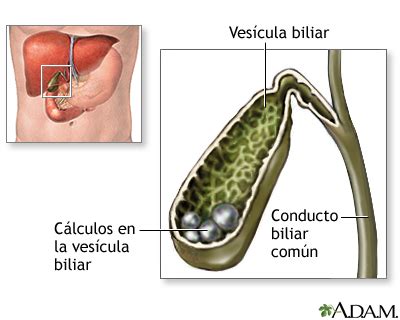 Cálculos biliares: MedlinePlus enciclopedia médica